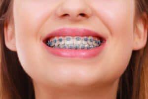 Know About Orthdontics and a Beautiful Smile